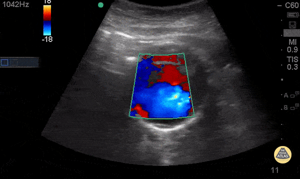 Aorta - Mural Thrombus in AAA - Doppler