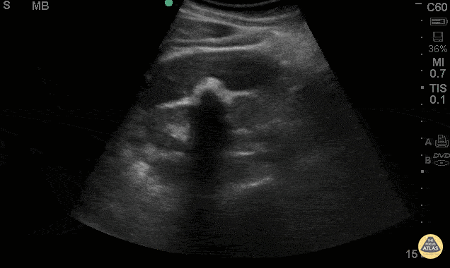 Biliary - Wall Echo Shadow