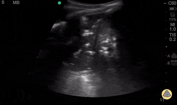 Pulmonary - Air Bronchograms