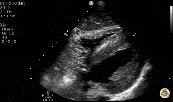 Normal Cardiac Anatomy - Central Line Confirmation