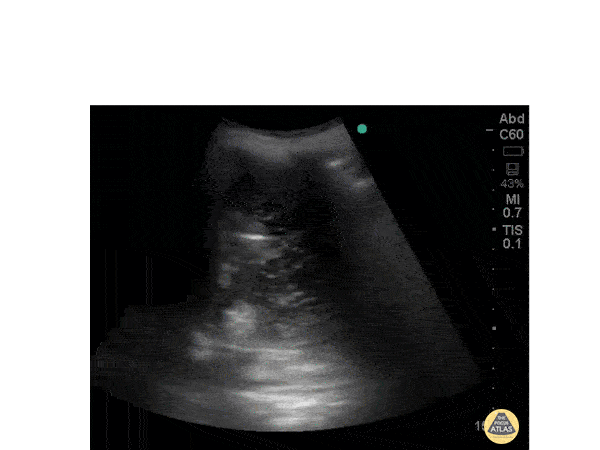 Pulmonary - Pleural Effusion
