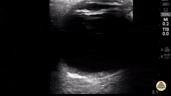 Orbital - Lense Replacement