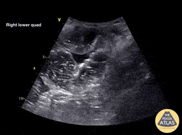 Bowel-GI - Small Bowel Obstruction