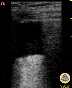 Pulmonary - Hydropoint