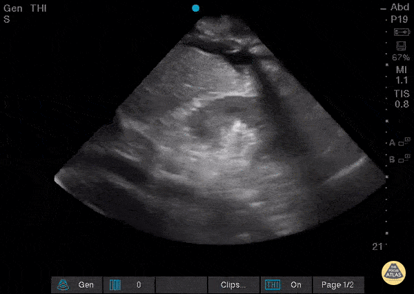 Pulmonary - Diaphragmatic Contraction
