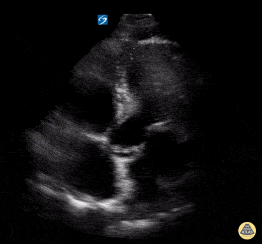 Normal Cardiac Anatomy - Apical 5 Chamber - Normal