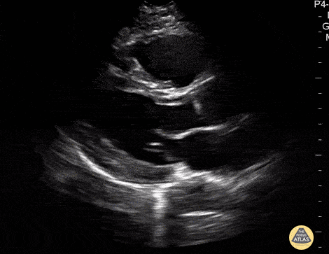 Normal Cardiac Anatomy - Parasternal Long Axis - Normal