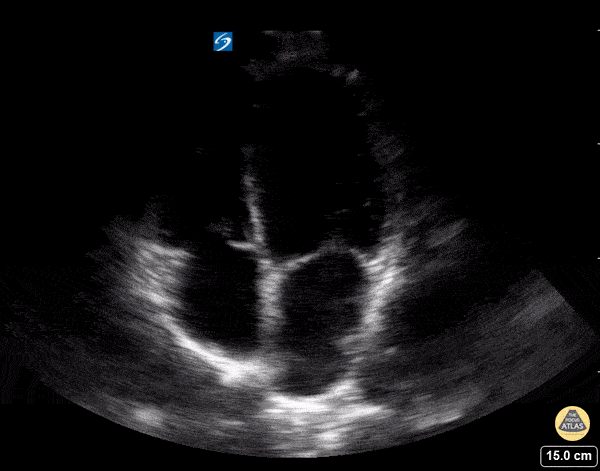 Normal Cardiac Anatomy - Apical Four Chamber - Normal