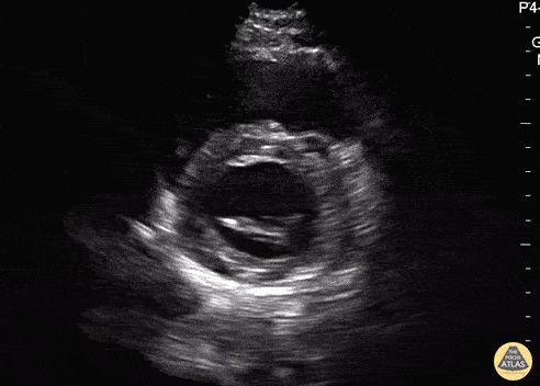 Normal Cardiac Anatomy - Parasternal Short Axis (Mitral Valve) - Normal