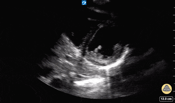 Normal Cardiac Anatomy - Parasternal Short Axis - Normal