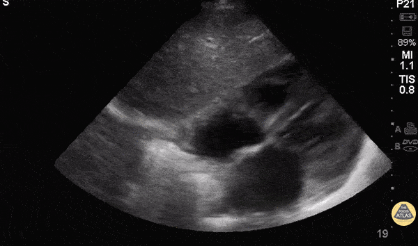 Normal Cardiac Anatomy - Subxiphoid / Subcostal - Normal Anatomy