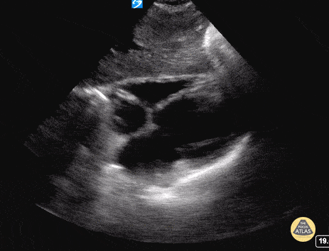 Normal Cardiac Anatomy - Subxiphoid / Subcostal - Normal