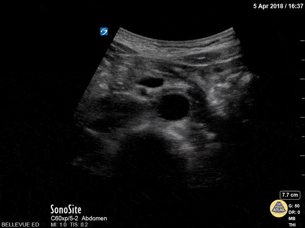 Aorta - Distal Aorta
