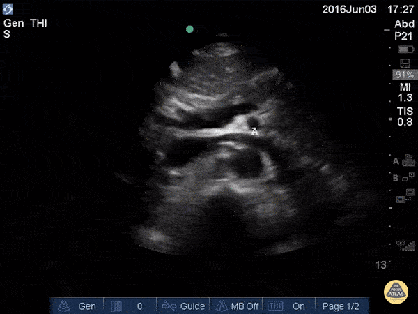 Aorta - Proximal Aorta Anatomy