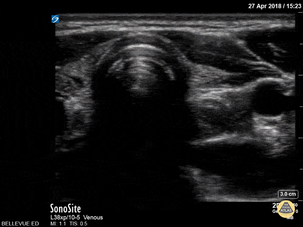 Bowel-GI - Esophagus Swallowing