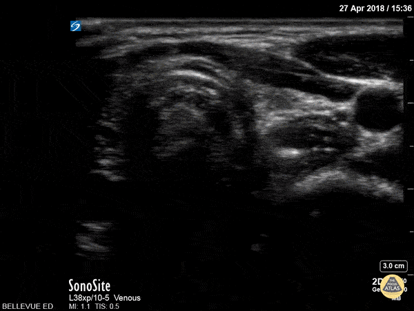 Soft Tissue - Thyroid Left Lobe