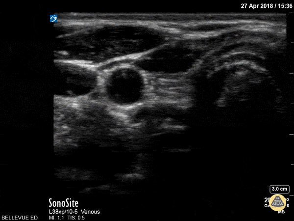 Soft Tissue - Thyroid Right Lobe