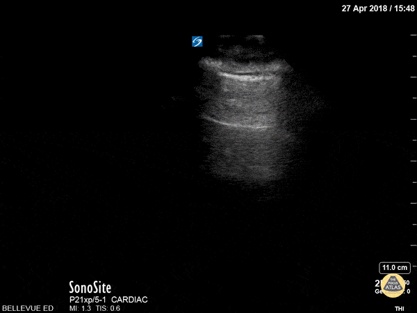 Pulmonary - Lung Sliding and A-lines