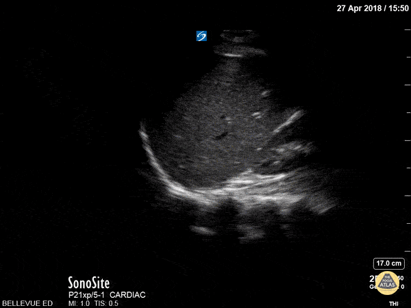 Pulmonary - Pleural Space
