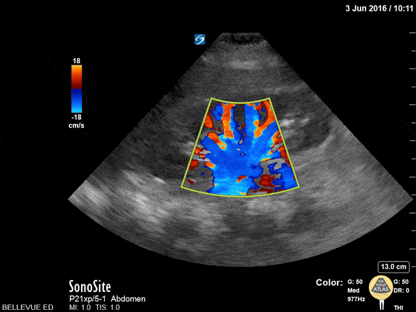 Renal/GU - Kidney Doppler