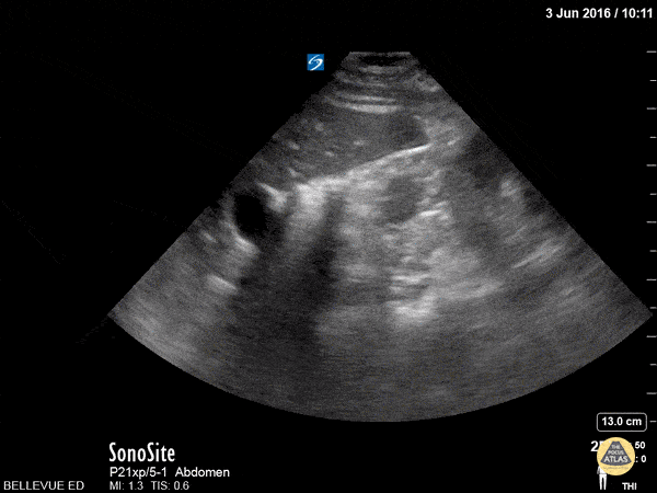 Renal/GU - Kidney Transverse
