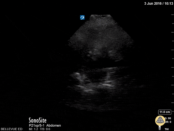 Renal/GU - LUQ Kidney Long Axis