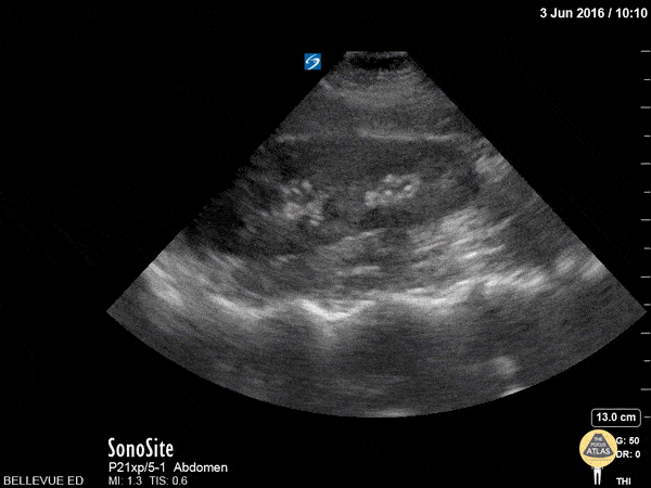 Renal/GU - RUQ Kidney Long Axis