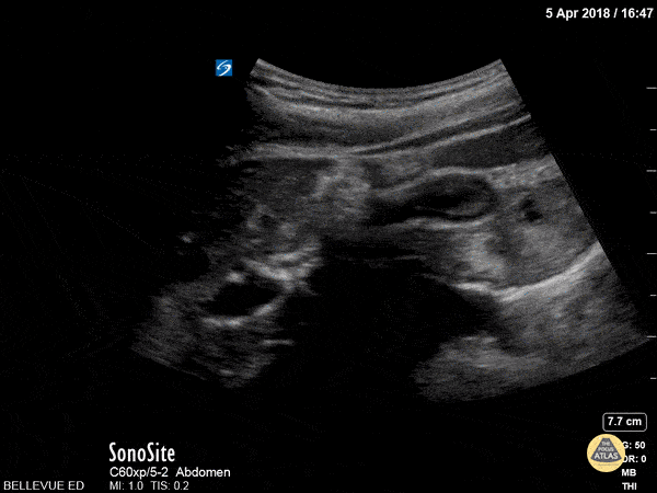 Biliary - Contracted Gallbladder