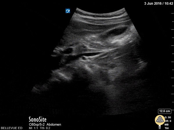Biliary - Gallbladder Long Axis