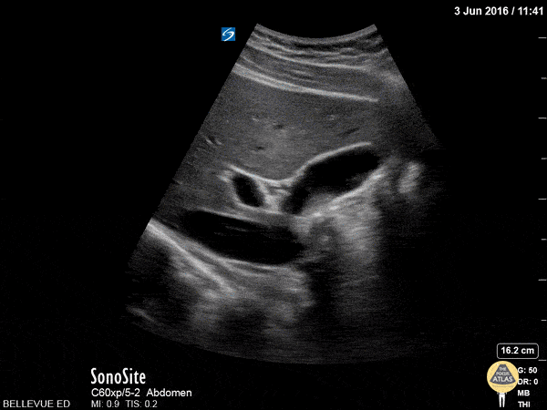 Biliary - Gallbladder and CBD