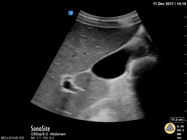 Biliary - Gallbladder and Right Hepatic Artery