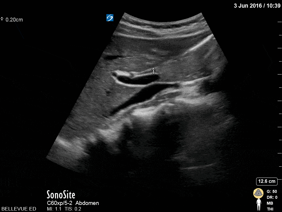 Biliary - Olive Sandwich