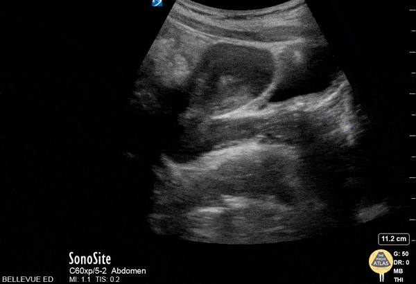OB/Gyn - Transabdominal Uterus Long Axis