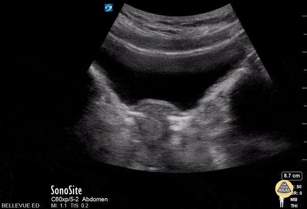 OB/Gyn - Transabdominal Uterus Transverse