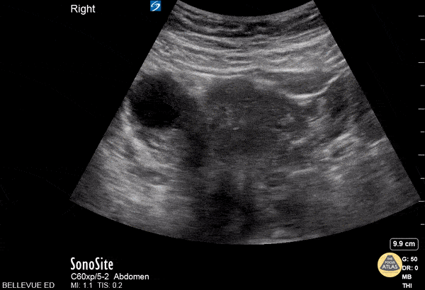 OB/Gyn - Transabdominal Right Adnexa with Ovarian Cyst