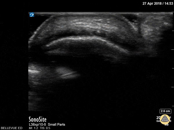 Musculoskeletal - Achilles Tendon Short Axis