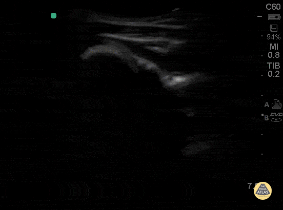 Musculoskeletal - Normal Shoulder