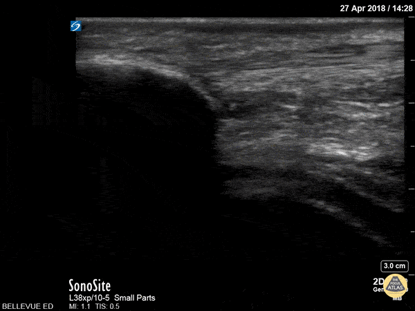 Musculoskeletal - Patellar Tendon