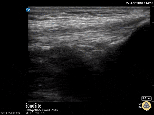 Musculoskeletal - Quadriceps Tendon