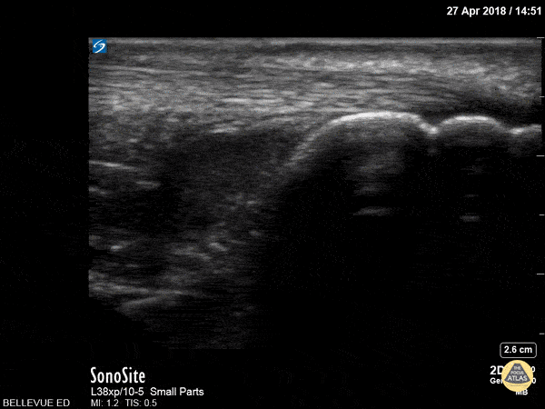 Musculoskeletal - Achilles Tendon