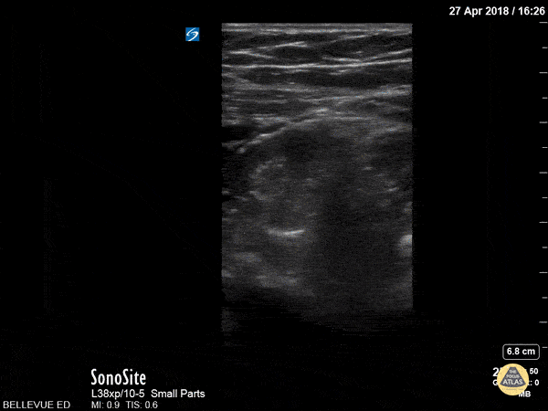 Bowel-GI - Large Bowel