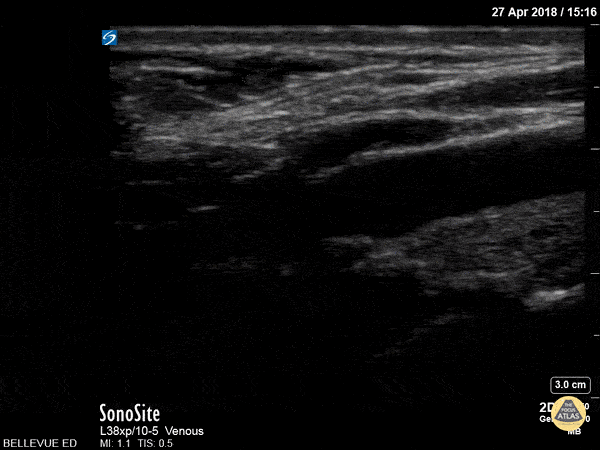 Vascular - Carotid Bulb Long Axis