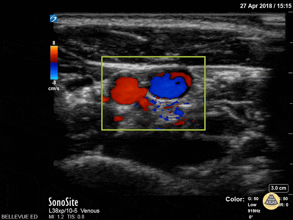 Vascular - Carotid and IJ - Doppler