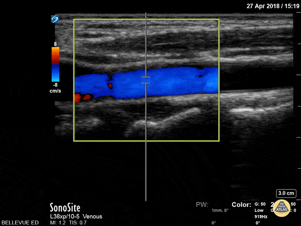 Vascular - Carotid Long - Doppler