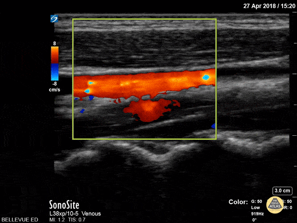 Vascular - Carotid vs IJ - Doppler