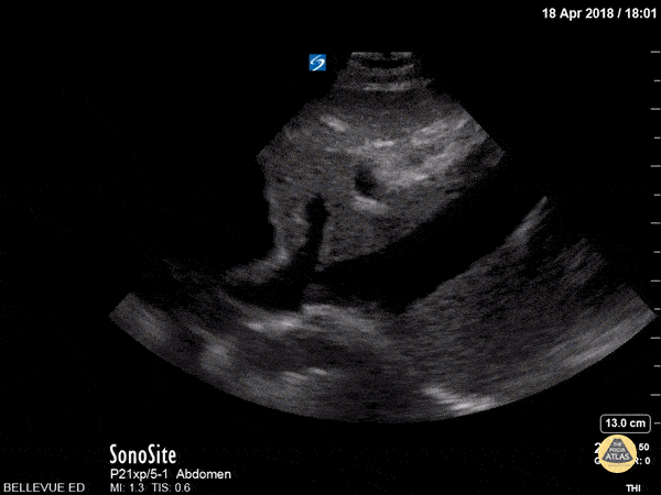 Vascular - IVC and Hepatic Vein