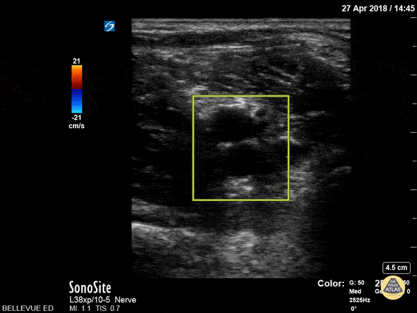 Vascular - Popliteal Vasculature - Doppler