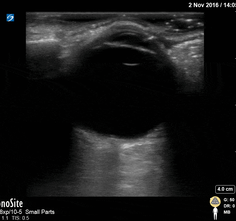Orbital - Normal Eye Anatomy
