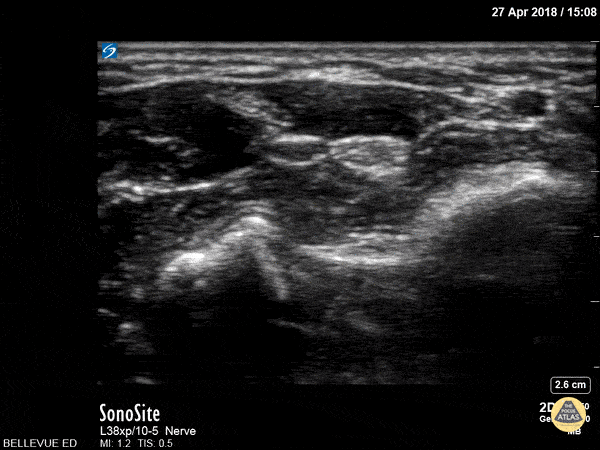 Nerve Block Gallery - Median Nerve