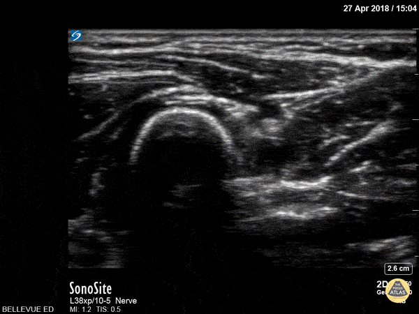 Nerve Block Gallery - Radial Nerve